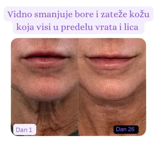 Elana Uređaj sa Mikrostrujom - ElanaSkin